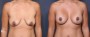 Dr. Saltz Breast Lift Patient 12