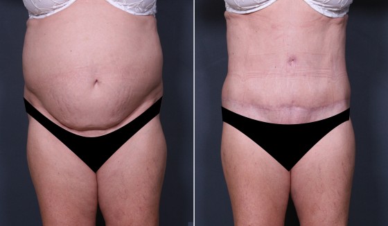 Dr. Saltz Tummy Tuck Patient 1