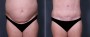 Dr. Saltz Tummy Tuck Patient 1