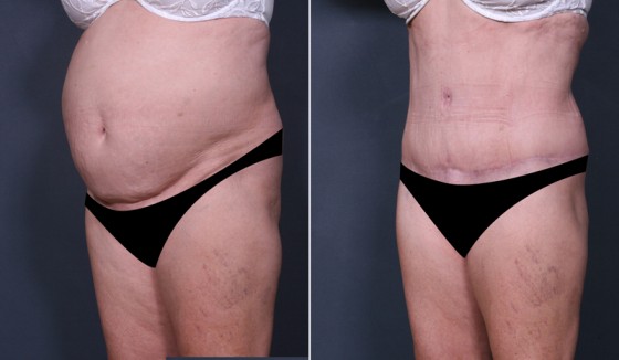 581600abdominoplastyLHS2