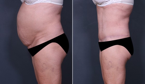 581600abdominoplastyLHS3