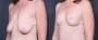 Dr. Saltz Breast Lift Patient 10