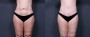 Dr. Saltz Tummy Tuck Patient 12