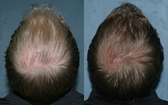 581842HairTransplant1