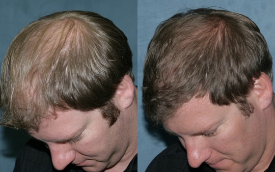 581842HairTransplant2