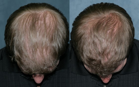 581842HairTransplant3
