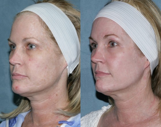 582039PortraitRepairAlexVbeam2