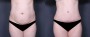 Dr. Grzeskiewicz Tummy Tuck Patient 9