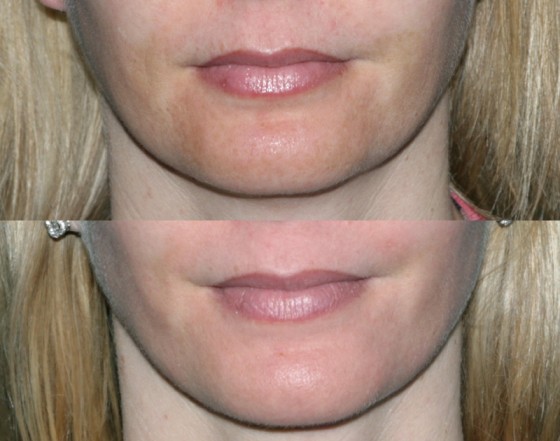 582419Repairmelasma1-2