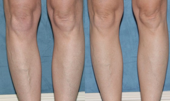 582822Vein1-2