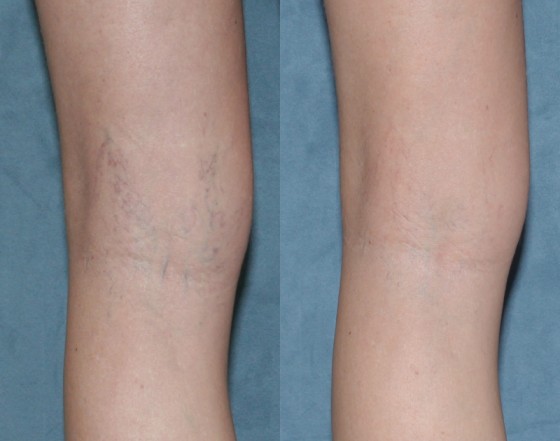 582822Vein1