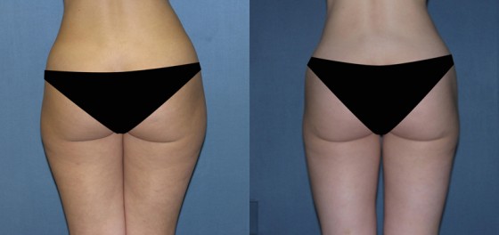 JLGLIPO2