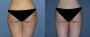 Dr. Grzeskiewicz Liposuction Patient 1