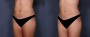 Dr. Grzeskiewicz Liposuction Patient 2