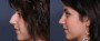 Dr. Brahme Rhinoplasty Patient 1