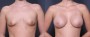 Dr. Grzeskiewicz Breast Augmentation Patient 18