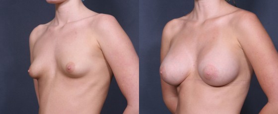583188BreastAugJLG