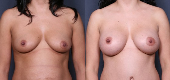 583755LHSBreast