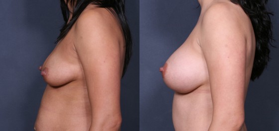 583755LHSBreast3