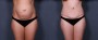 Dr. Saltz Tummy Tuck Patient 10