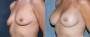Dr. Roark Breast Augmentation Patient 7