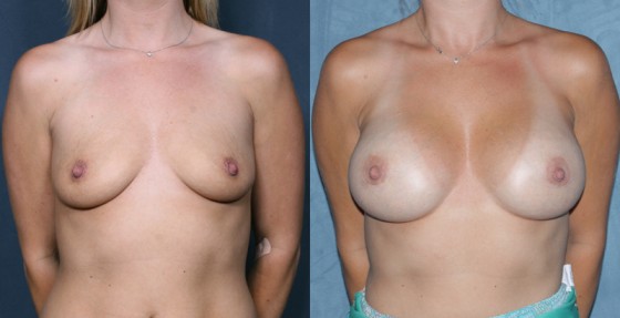 583887BreastAug1