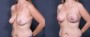 Dr. Grzeskiewicz Breast Lift Patient 3