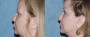 Dr. Roark Facelift Patient 5