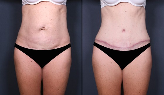 584290AbdominoplastyJLG copy