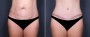 Dr. Grzeskiewicz Tummy Tuck Patient 4