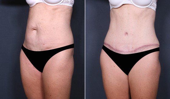 584290AbdominoplastyJLG2 copy