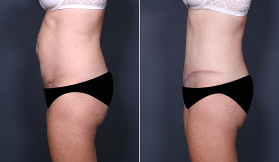 584290AbdominoplastyJLG3 copy