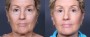 Dr. Brahme Facelift Patient 6