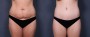 Dr. Brahme Tummy Tuck Patient 7