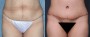 Dr. Roark Tummy Tuck Patient 12
