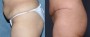 Dr. Roark Tummy Tuck Patient 13