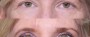 Dr. Brahme Eyelid Lift Patient 1