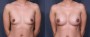 Dr. Grzeskiewicz Breast Augmentation Patient 13