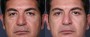 Dr. Grzeskiewicz Eyelid Lift Patient 1