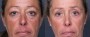 Dr. Brahme Eyelid Lift Patient 7