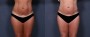 Dr. Brahme Liposuction Patient 5