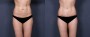 Dr. Grzeskiewicz Tummy Tuck Patient 7