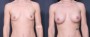 Dr. Saltz Breast Augmentation Patient 40