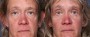 Dr. Brahme Eyelid Lift Patient 6
