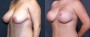 Dr. Grzeskiewicz Breast Lift Patient 8