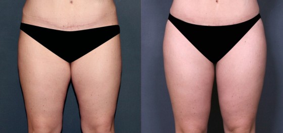 587113lipo