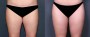 Dr. Grzeskiewicz Liposuction Patient 5