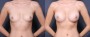 Dr. Grzeskiewicz Breast Augmentation Patient 1