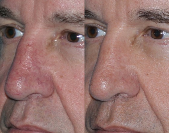 587855VBeamDetail1