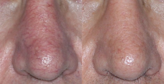 587855Vbeamdetail1-2